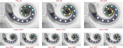 Systematic Literature Review of Hearing Preservation Rates in Cochlear Implantation Associated With Medium- and Longer-Length Flexible Lateral Wall Electrode Arrays
